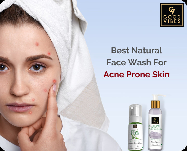 Girl with acne pimple, Best Natural Face Wash For Acne Prone Skin