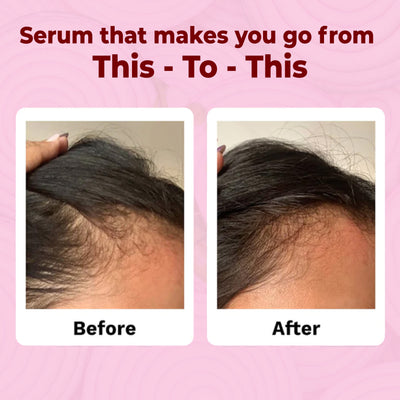 Hairfall Control Onion Scalp Serum | Onion Extracts | Induced Anagain | Healthy Hair Growth | Hair Nourishment | Enhances volume | All hair Types